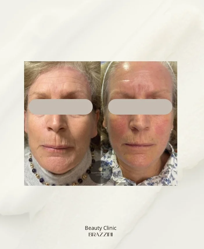 Client result at Beauty Clinic Brazzini Battersea — facial aesthetics treatment