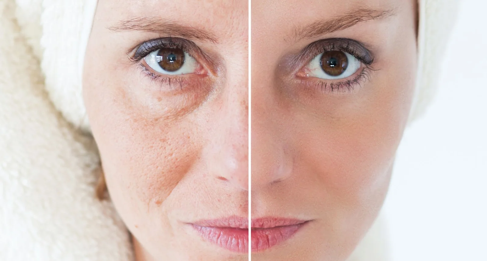 Injectable Treatments in Battersea